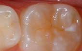 Tooth before sealant applied - Pediatric Dentist in Keller, Fort Worth and Southlake, TX - Bridget McAnthony, DDS