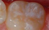 Tooth after sealant applied - Pediatric Dentist in Keller, Fort Worth and Southlake, TX - Bridget McAnthony, DDS